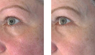 vivace-microneedling-before-and-after-1.jpg