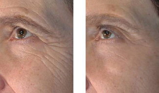 vivace-microneedling-before-and-after-2.jpg