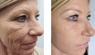 vivace-microneedling-before-and-after-3.jpg