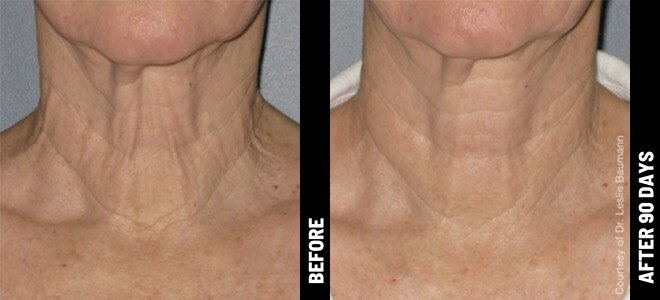 ultherapy-before-and-after-2.jpg