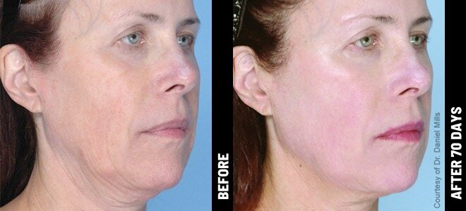 ultherapy-before-and-after-1.jpg