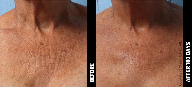 ultherapy-before-and-after-3.jpg