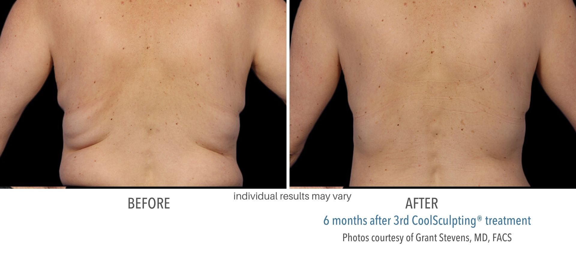 coolsculpting_for_men_before_and_after_Denville_NJ_2.jpg