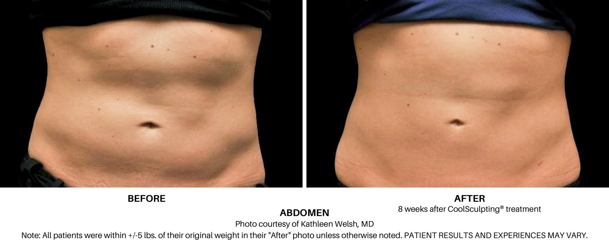 female_coolsculpting_abdomen_before_and_after_01-scaled.jpg