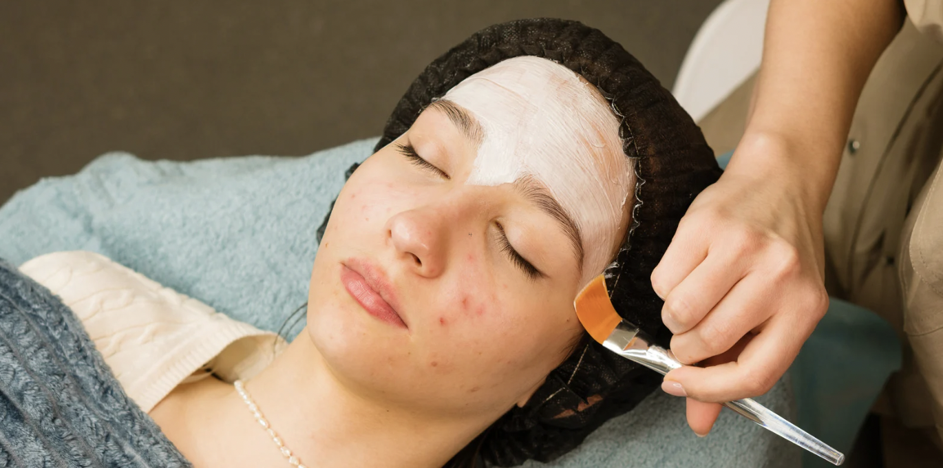 Discover the Best Acne Facial in Maple Lawn