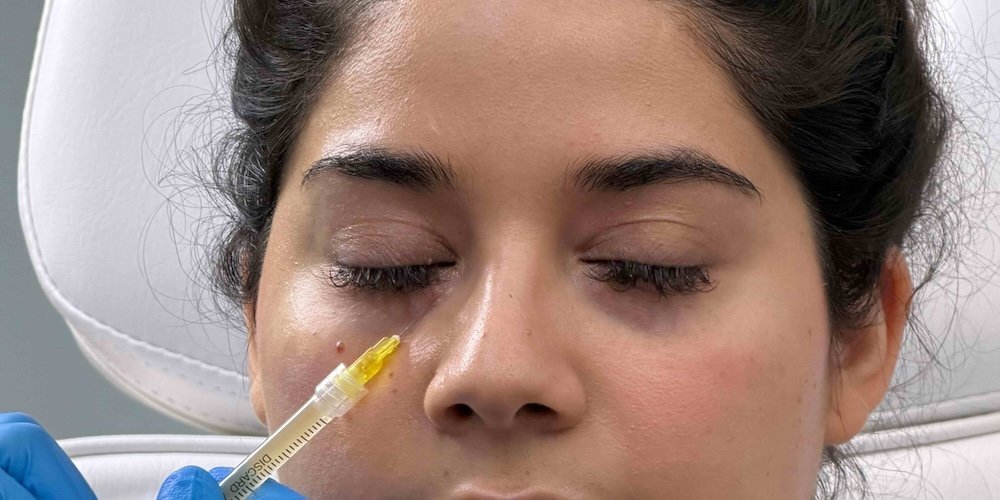 Under Eye Filler Appointments in Columbia, MD for Dark Circles and Hollow Eyes