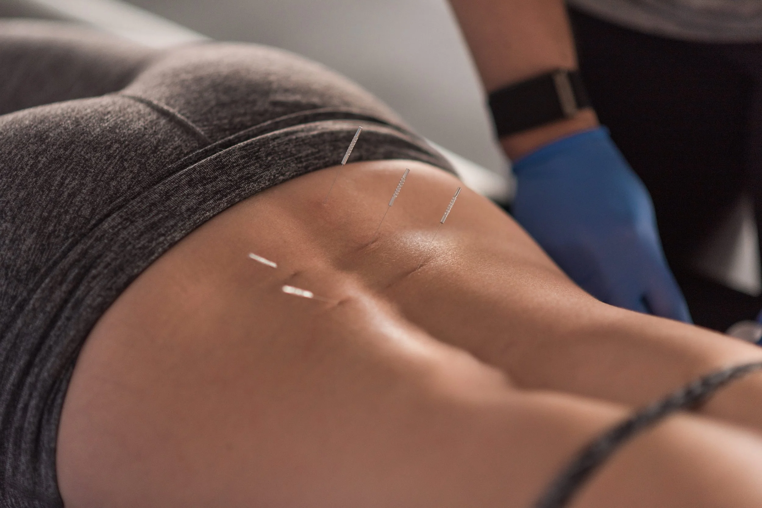 dry-needling-low-back-injury-milford-NH.jpg