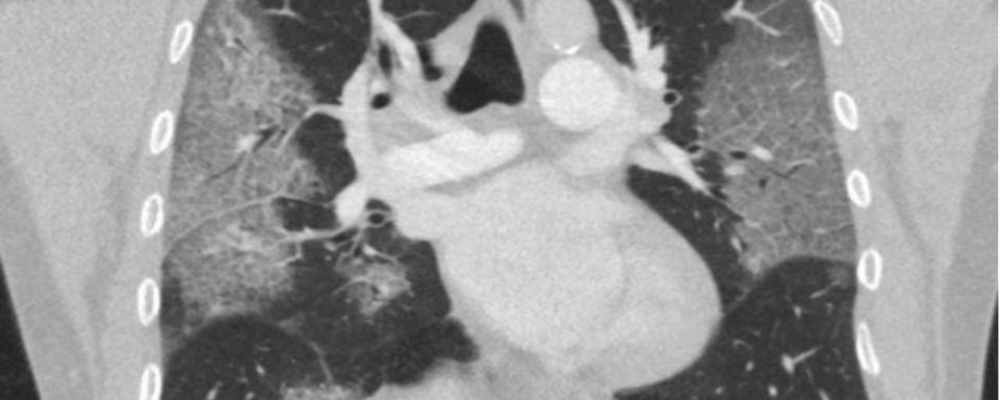 Automated COVID-19 Detection