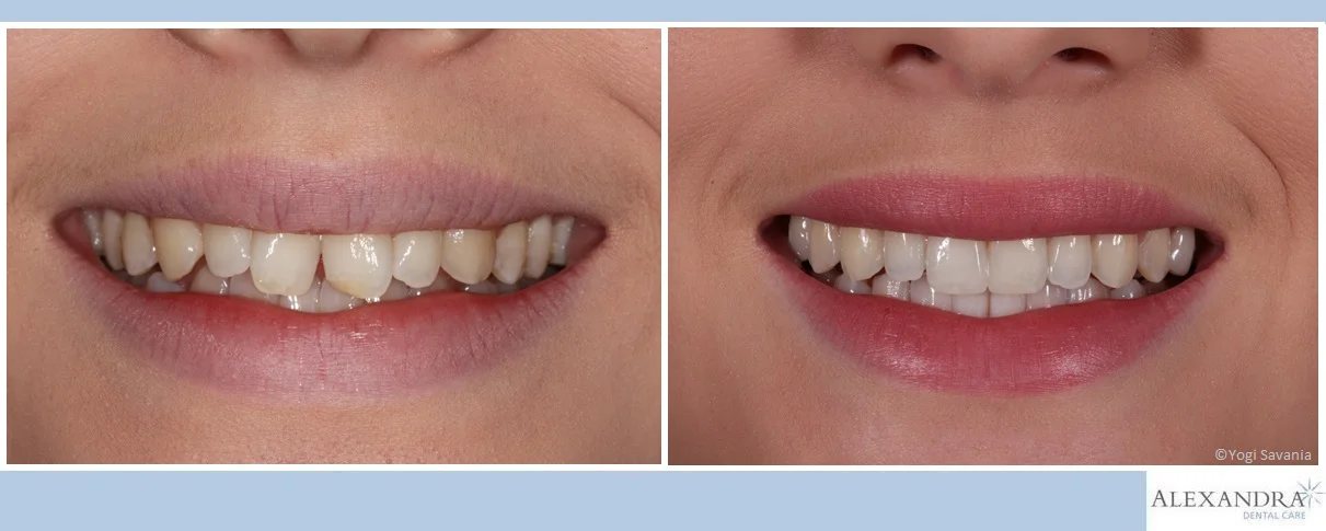 DS before- after.jpg