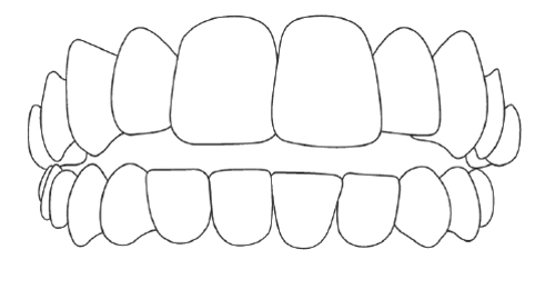 Open Bite.jpg