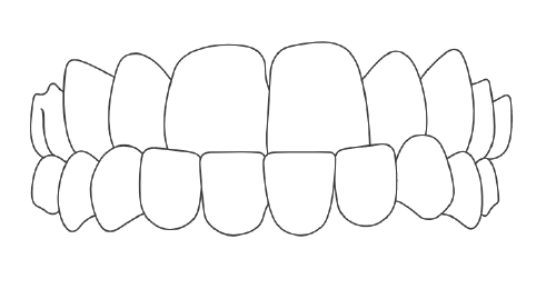 Under Bite.jpg