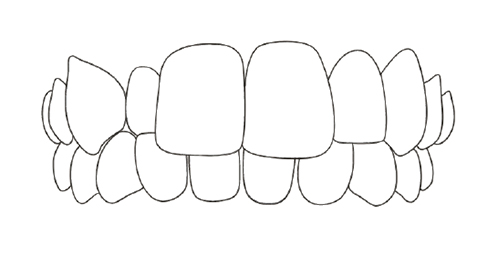 Cross bite.jpg