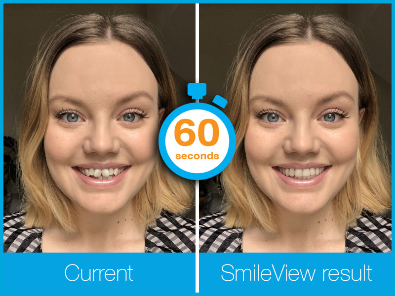 Invisalign Smileview in 60 seconds.jpg