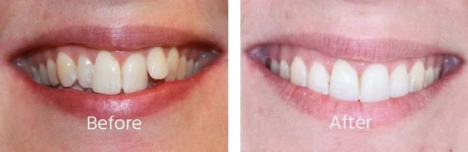 Teeth-Sratightening-Case-Andover.jpg