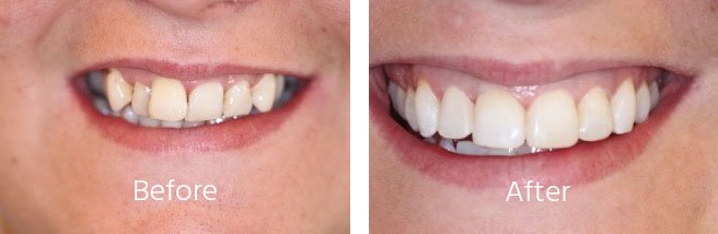 Teeth-Sratightening-Case-Andover-1.jpg