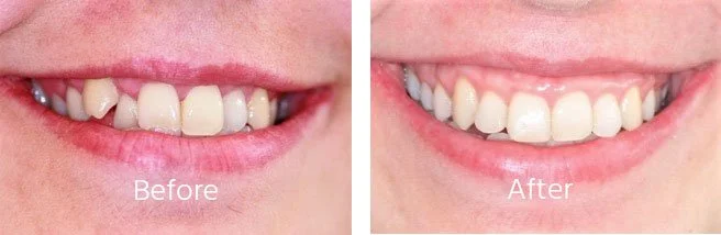 Teeth-Sratightening-Case-Andover-2.jpg