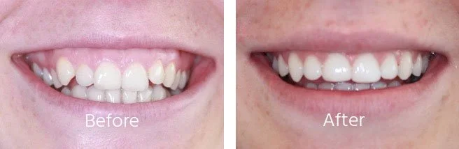 Teeth-Sratightening-Case-Andover-3.jpg