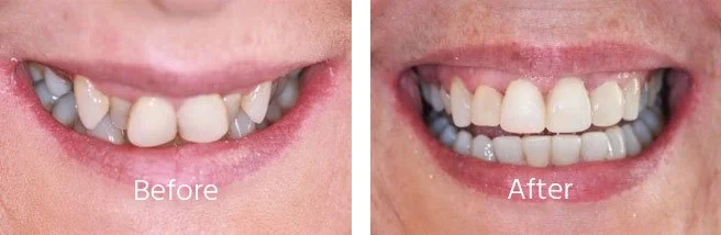 Teeth-Sratightening-Case-Andover-4.jpg