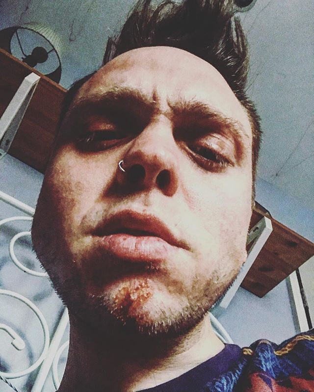 Love your battered self 🤕💙💛
.
.
.
.
#booboo #selfie #metime #loveyourself #grunge