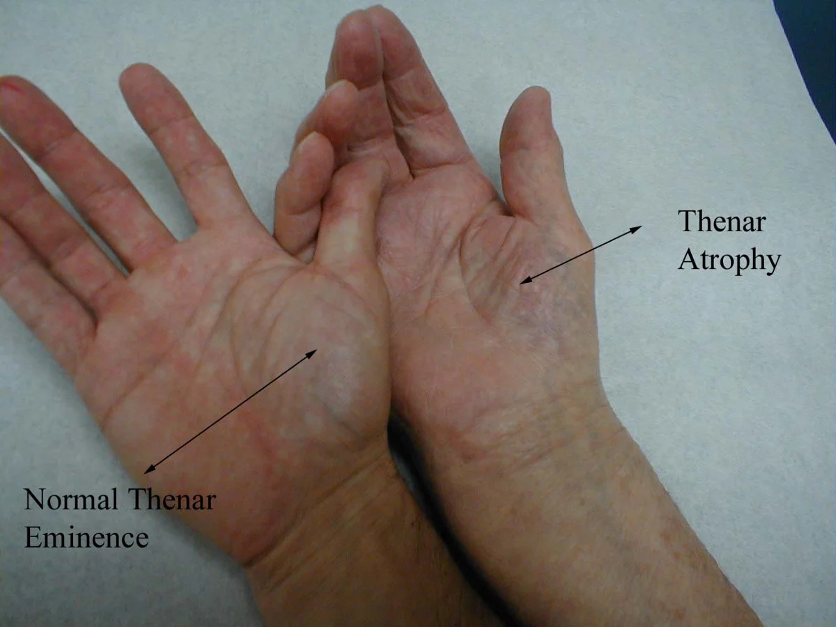 What is Carpal Tunnel? — Lattimore Physical Therapy