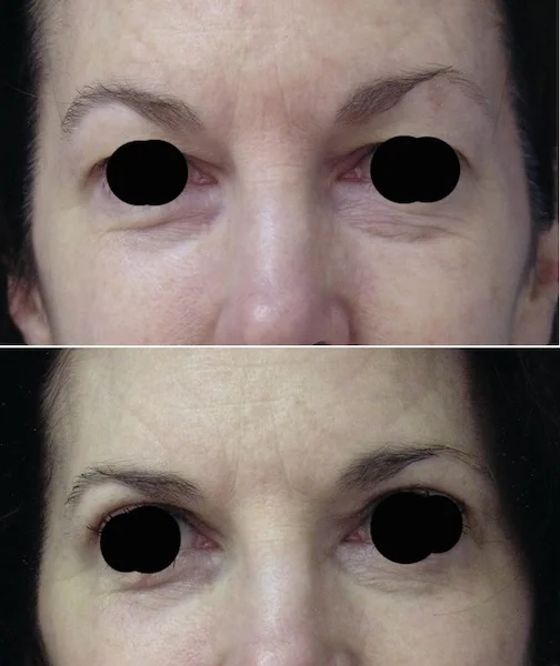 Upper Eyelid Surgery