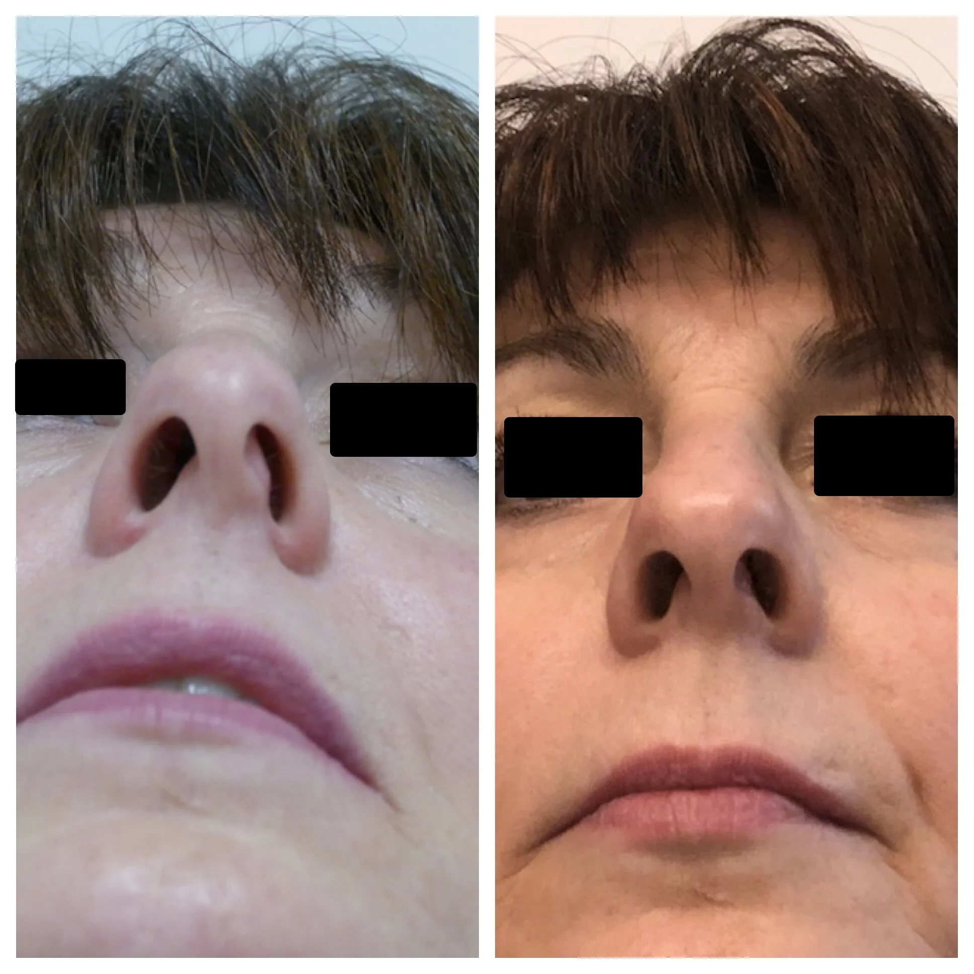 Tiplasty