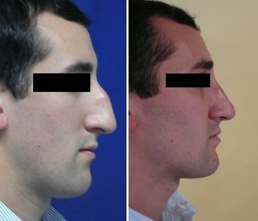 Male Nose Surgery