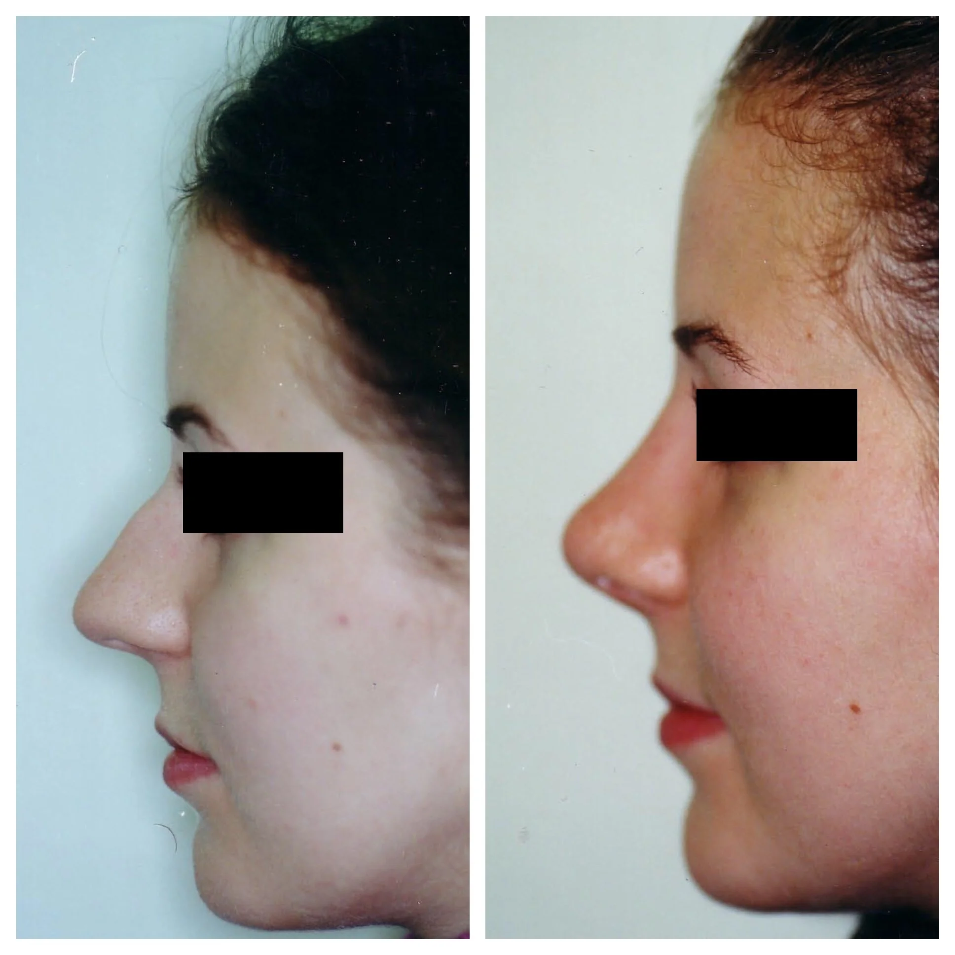 Rhinoplasty and Tiplasty