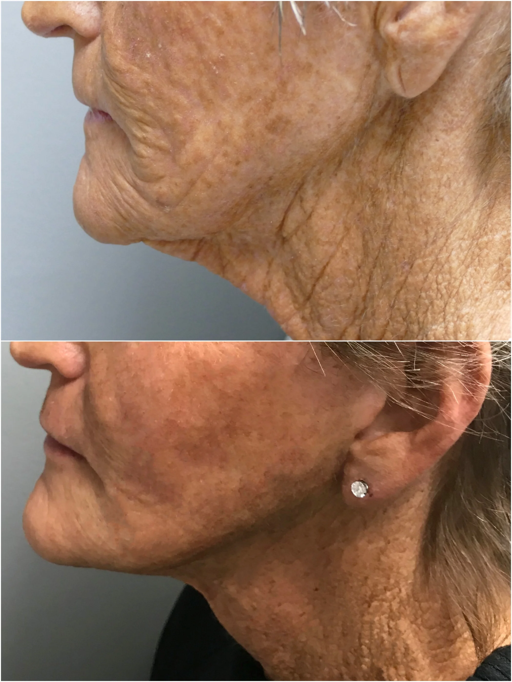 Facelift and Necklift Surgery