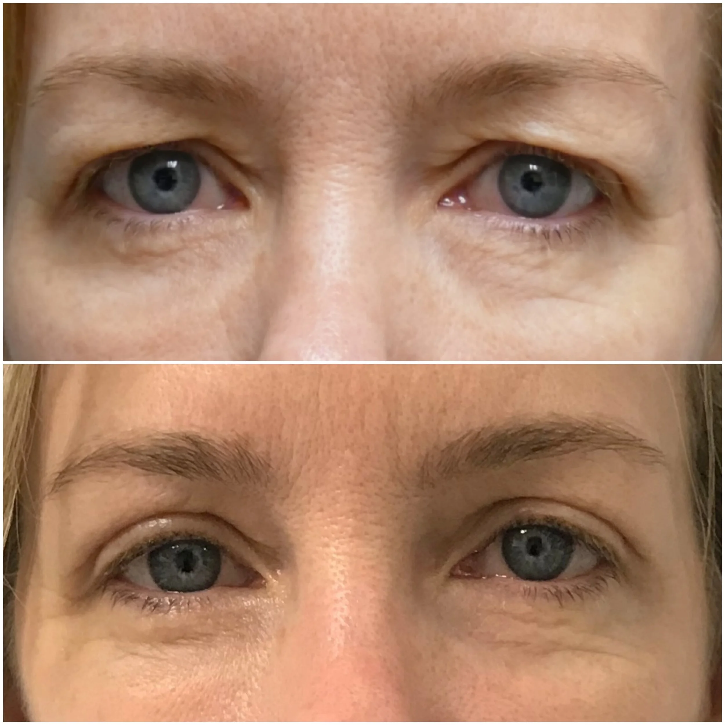 Upper Eyelid Surgery