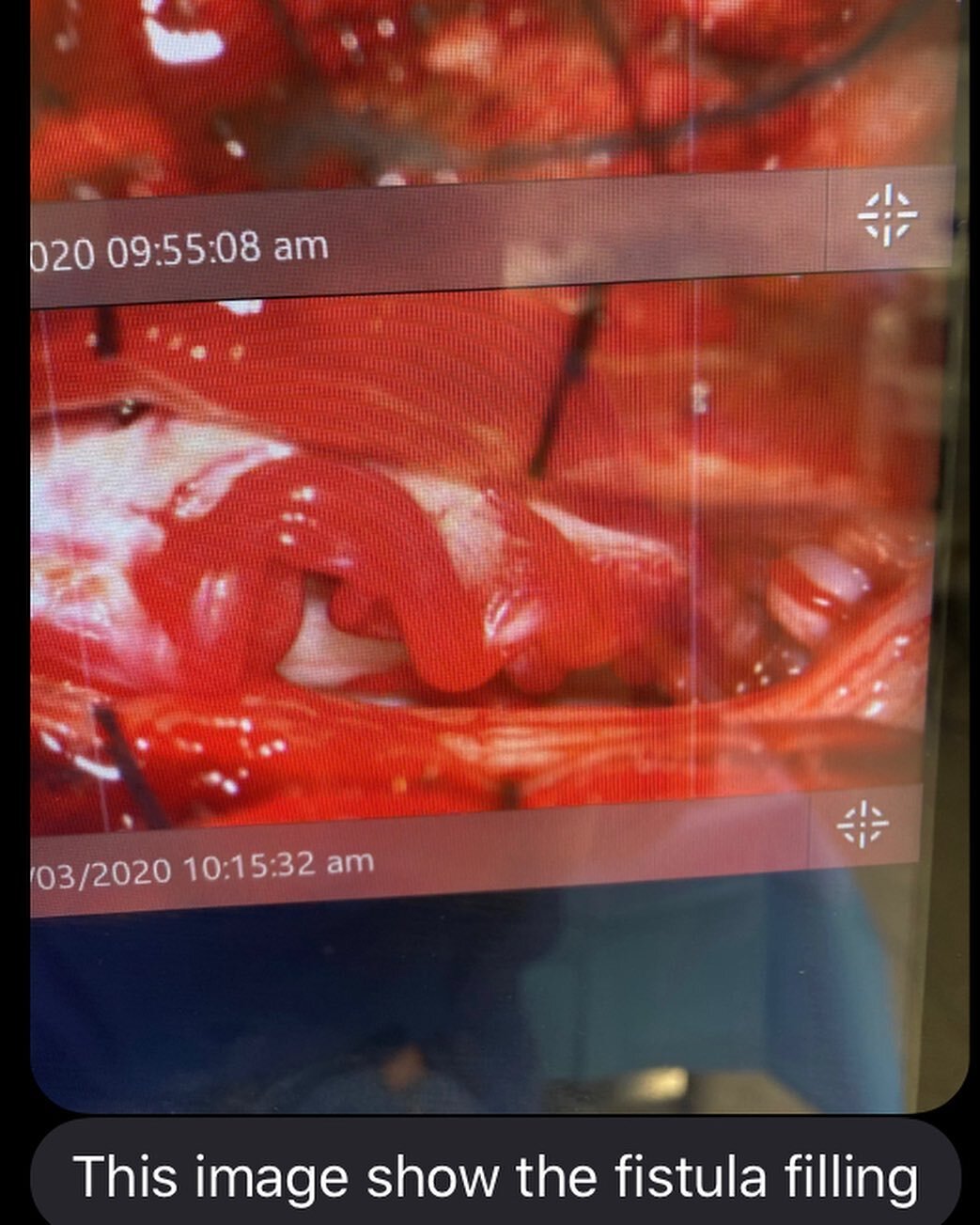 ⛑Follow up to our patient with a spinal AV fistula:

Patient was taken to surgery by Dr. Kim Williams, one of our highly skilled Amita neurosurgeons. Dr. Williams was able to treat the AVF by cutting off its flow. Swipe left to check out the sequence