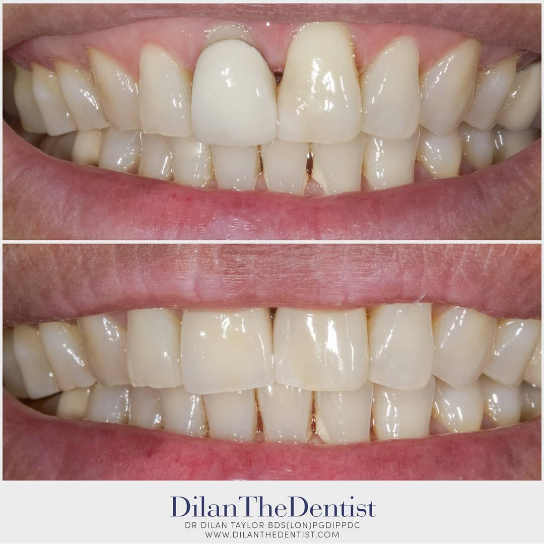 Swipe to view! After having her original crown placed over 20 years ago following a fall, this patient came seeking to improve her smile.

A combination of composite bonding &amp; a Zirconia crown were used.

Www.dilanthedentist.com

For bookings ema