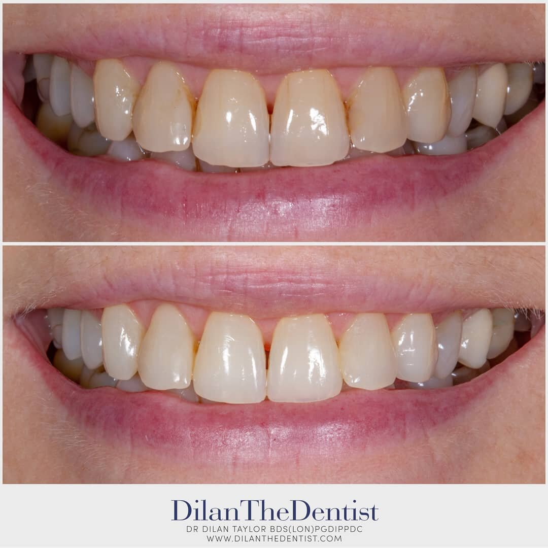Sometimes carefully planned professional tooth whitening, with some small composite bonding is just the thing needed to freshen up a smile.

Check out the profile for larger before and after photos.

Bookings at:
@prestwood_dental_health_centre 

Www