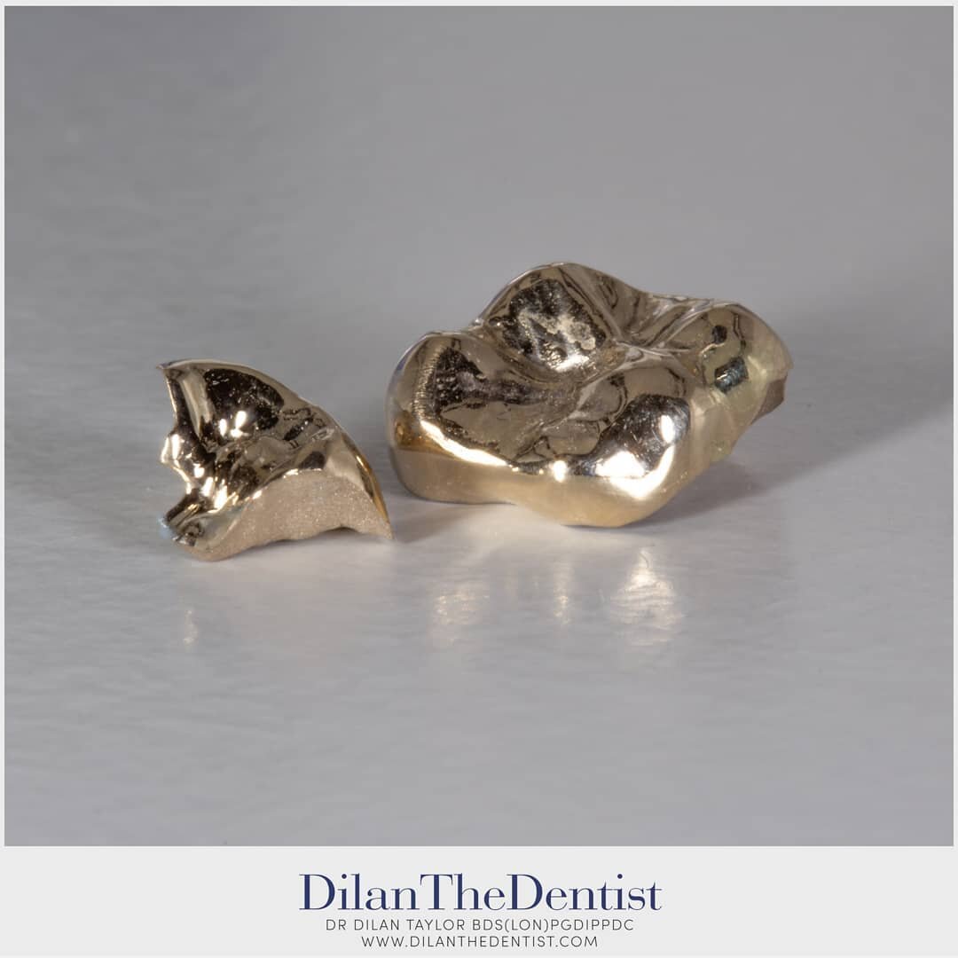 Being low in reactivity and relatively malleable- gold crowns can often last multiple decades! 

Making them my choice of material for restoring heavily worn or broken teeth in the non aesthetic zone.

Www.dilanthedentist.com
@prestwood_dental_health