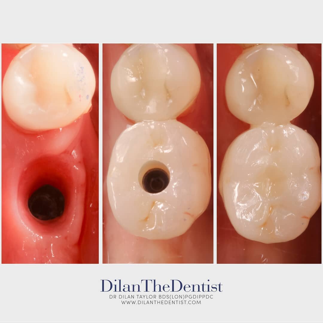 Stages of restoring a dental implant with a crown..

After carefully placing an implant many months ago, we restored it with an implant crown helping this patient to chew more efficiently and with confidence! 

Www.dilanthedentist.com
@prestwood_dent