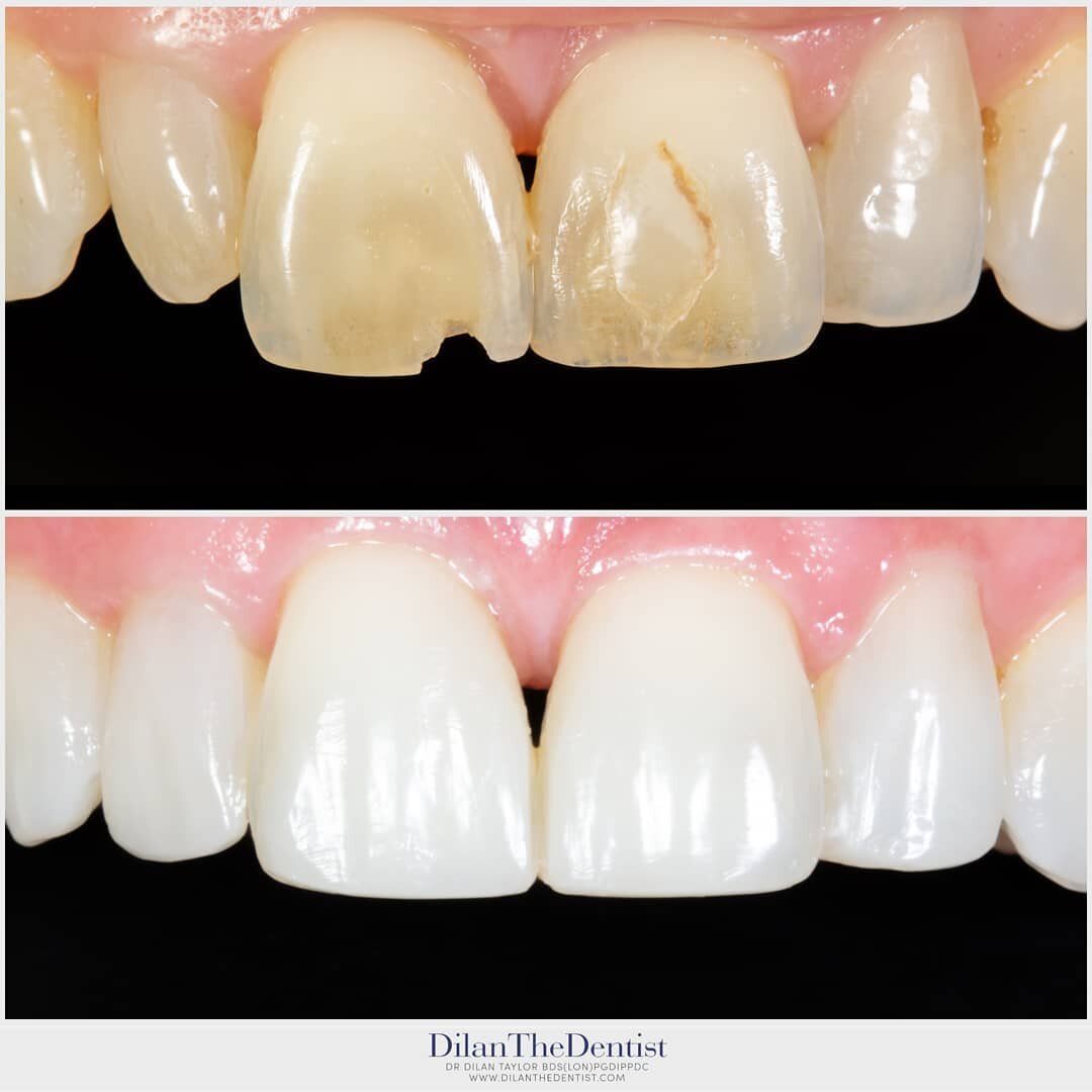 Professional tooth whitening &amp; Composite bonding.

Www.dilanthedentist.com

For bookings:
@prestwood_dental_health_centre

#biomimeticdentistry #dentistry #dentista #smiledesign #smile #smilemakeover #dentistry #dentalphotography #cosmeticdentist