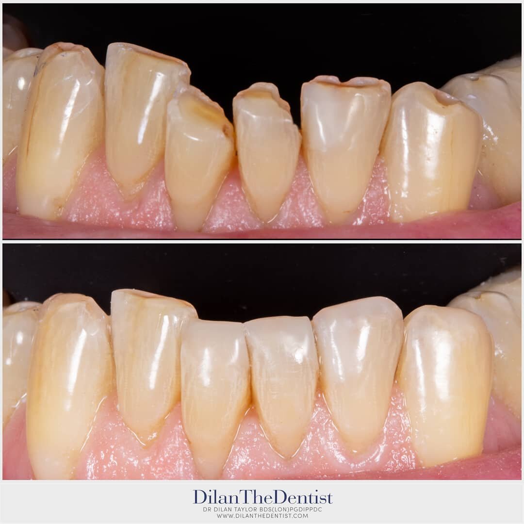 Touch ups of some weathered teeth using composite bonding.

Www.dilanthedentist.com
 @prestwood_dental_health_centre

#compositebonding #minimallyinvasivedentistry #dentalphotography #dentalcare #teeth #aylesbury #amersham #greatmissenden #keepitneat