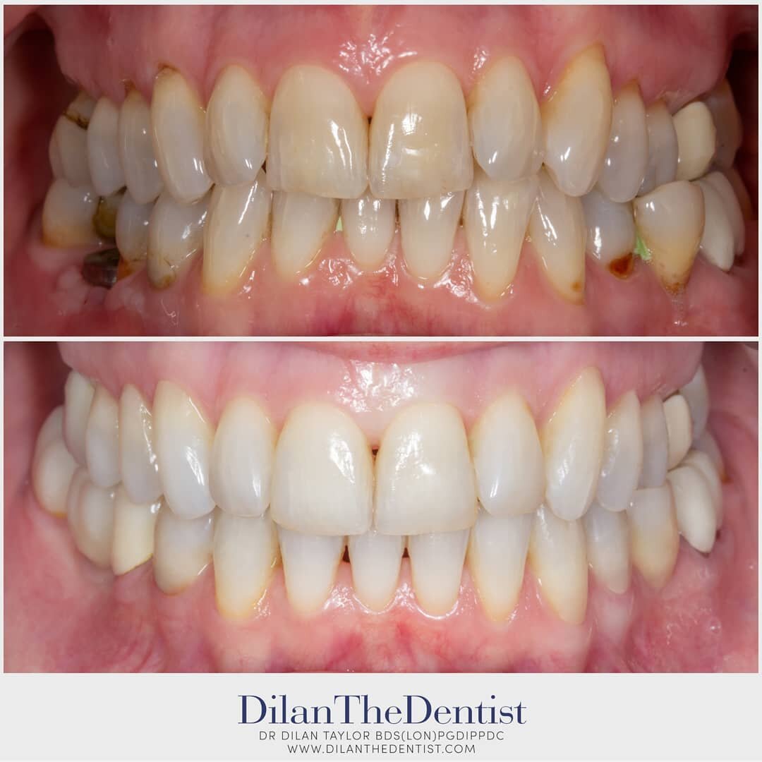 Some cases call for the use of multiple dental disciplines to achieve our patients goals.

Implants, invisalign, composite bonding, porcelain crowns

This lovely patients aims included-
Green: Malalignment of teeth- particularly her lower left back t