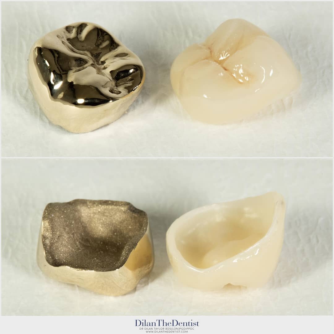 Whether it be the unbeatable longevity of gold or the natural appearance of a ceramic crown your after, working with skilled dental technicians makes all the difference! 

More about crowns:

Www.dilanthedentist.com/crowns

#crown #dentist #dentistry