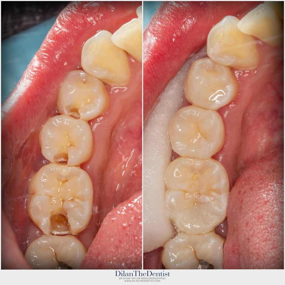 Having sensitivity on particular teeth? For this patient it turned out to be quite a bit of decay!

Restored with composite restorations @prestwood_dental_health_centre

DM for enquiries 

Www.dilanthedentist.com

#dentist #dentistry #biomimeticdenti