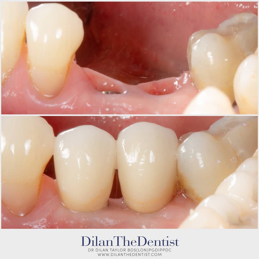 We all want to maintain a healthy smile and our chewing ability- here two dental implants have been placed and restored by yours truly to help my patient get closer to this goal.

@prestwood_dental_health_centre
Www.dilanthedentist.com 

#dentalhealt