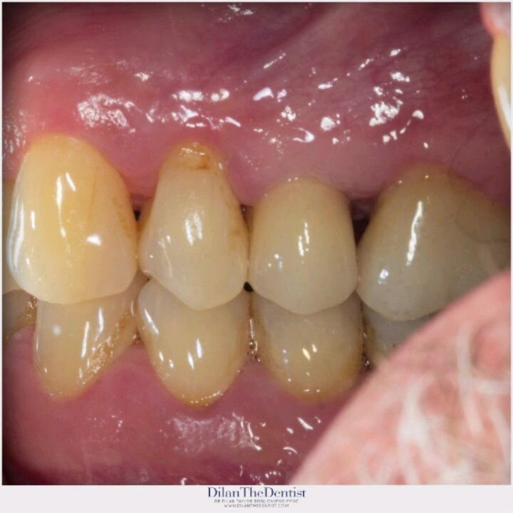 Swipe&lt;--- Sometimes life gives you lemons...and sometimes it gives you more crunch then you were after whilst eating! Here, a healthy tooth split in half during eating &amp; needed to be extracted

The tooth was replaced with a durable, natural lo