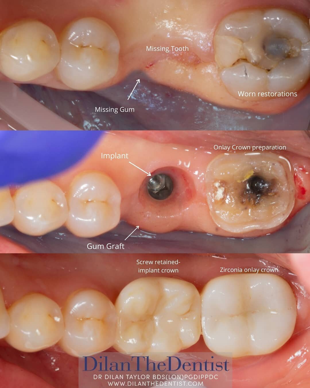 Taking longer to chew?

For this lovely patient we replenished the missing gum via a graft, and used an implant to replace her missing tooth.

We also fixed her worn molar, which had fracture lines and filled her premolar using a composite.

To see m