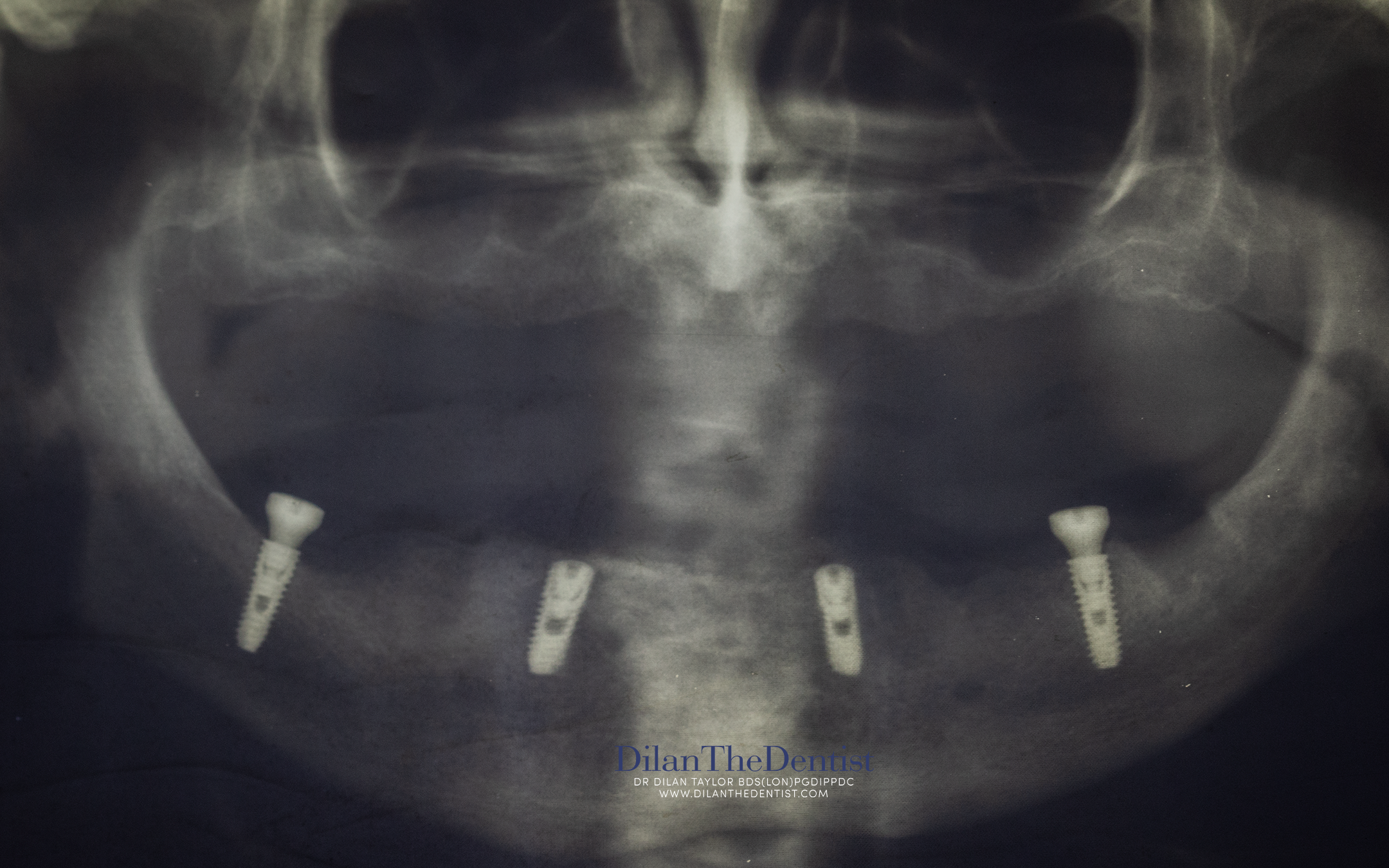 Immediately After Surgery