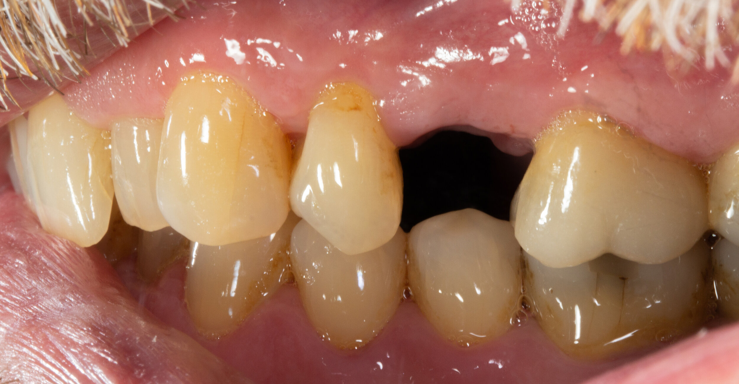 Premolar: Single Implant