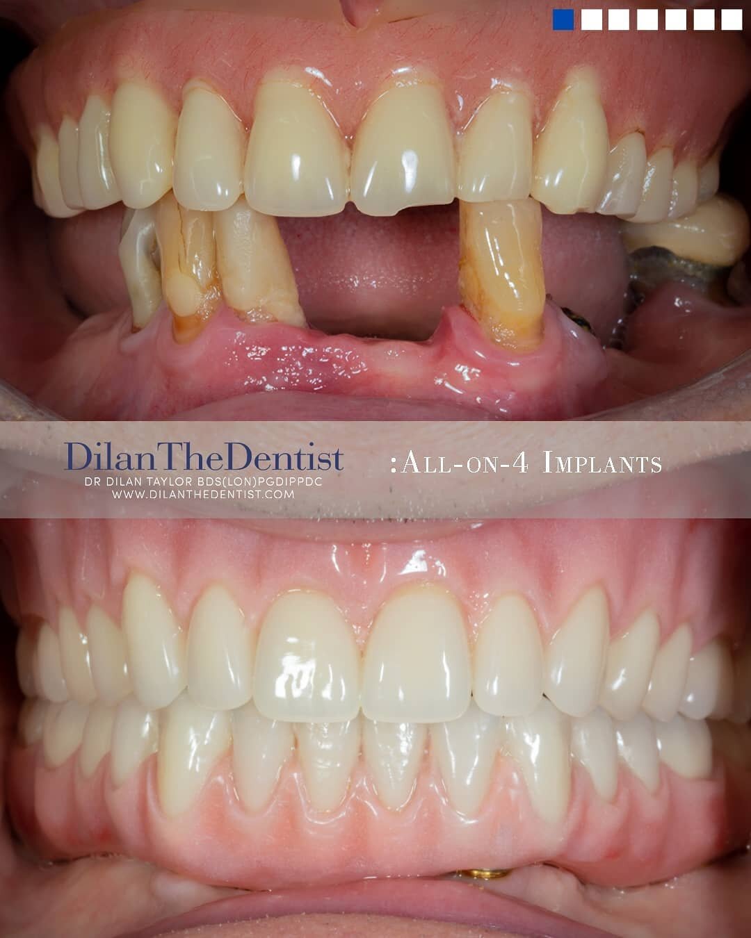 This gentlemen was referred to me to see what could be done after having increasing difficulities chewing his food.

After considering the pattern of on going toothless we decided upon removal of the remaining lower teeth, recontouring of the lower j