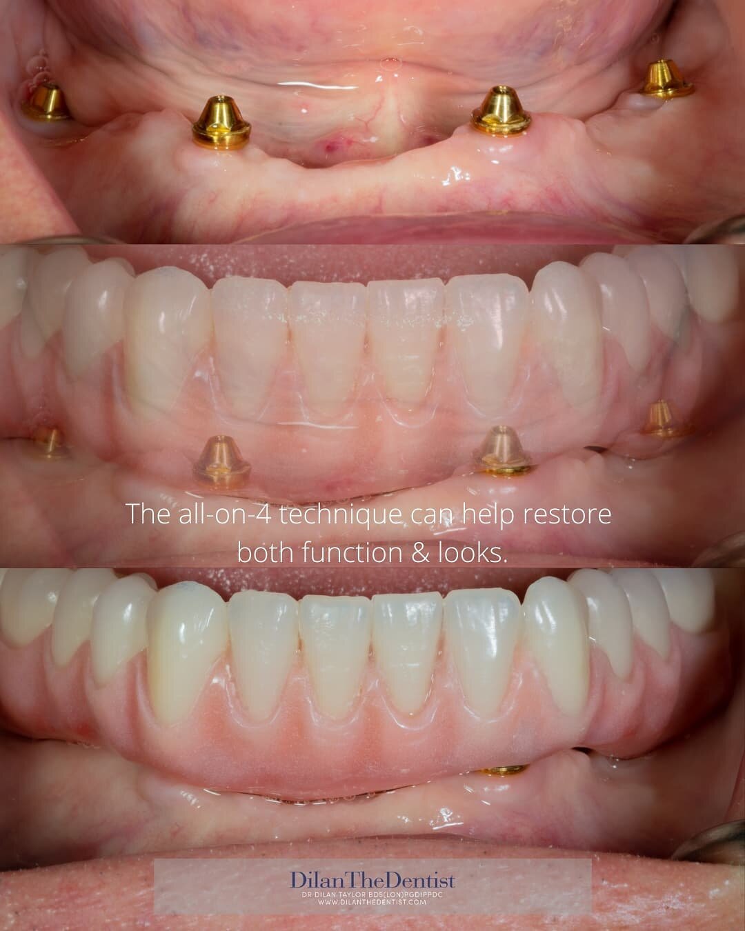 Blending function &amp; looks with an All-on-4 implant bridge

For more cases visit: www.dilanthedentist.com 

@osstemuk @prestwood_dental_health_centre
@oakview_dental

.

.

#dentalphotography #allon4 #allonfour #dentalimplants #implantdentistry #d