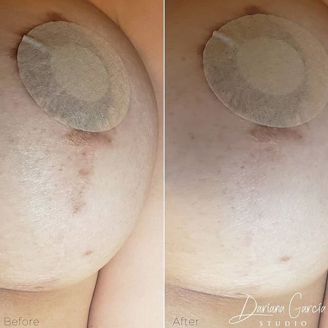 𝗦𝗰𝗮𝗿 𝗖𝗮𝗺𝗼𝘂𝗳𝗹𝗮𝗴𝗲 - a flat scar with a light color in the border are required to successfully treat a scar. Like in the picture ☝️☝️
⠀⠀⠀⠀⠀⠀⠀⠀⠀
You shouldn't feel any texture when you touch the scar to be considered a good candidate for th