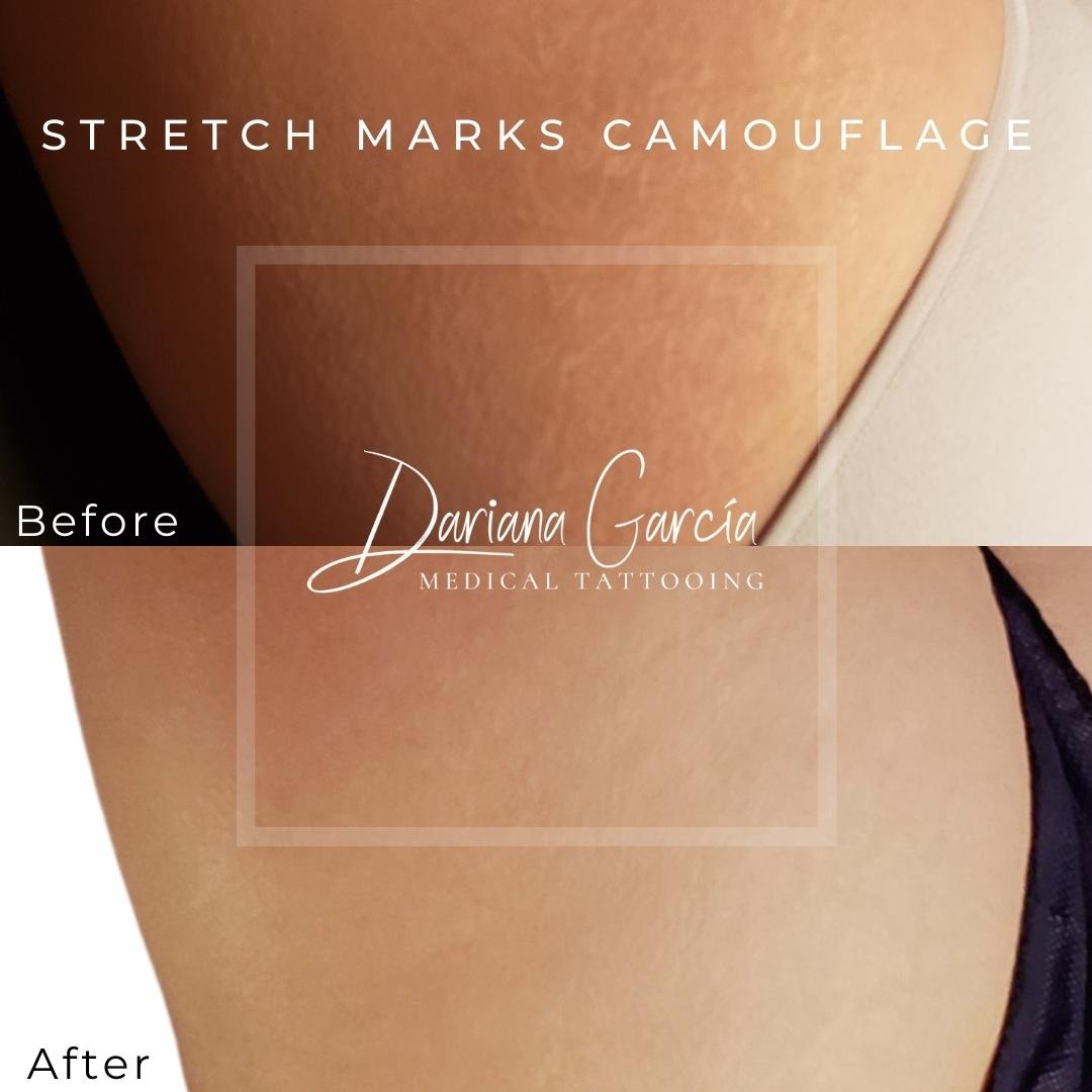 Stretch Marks Camouflage — Dariana Garcia