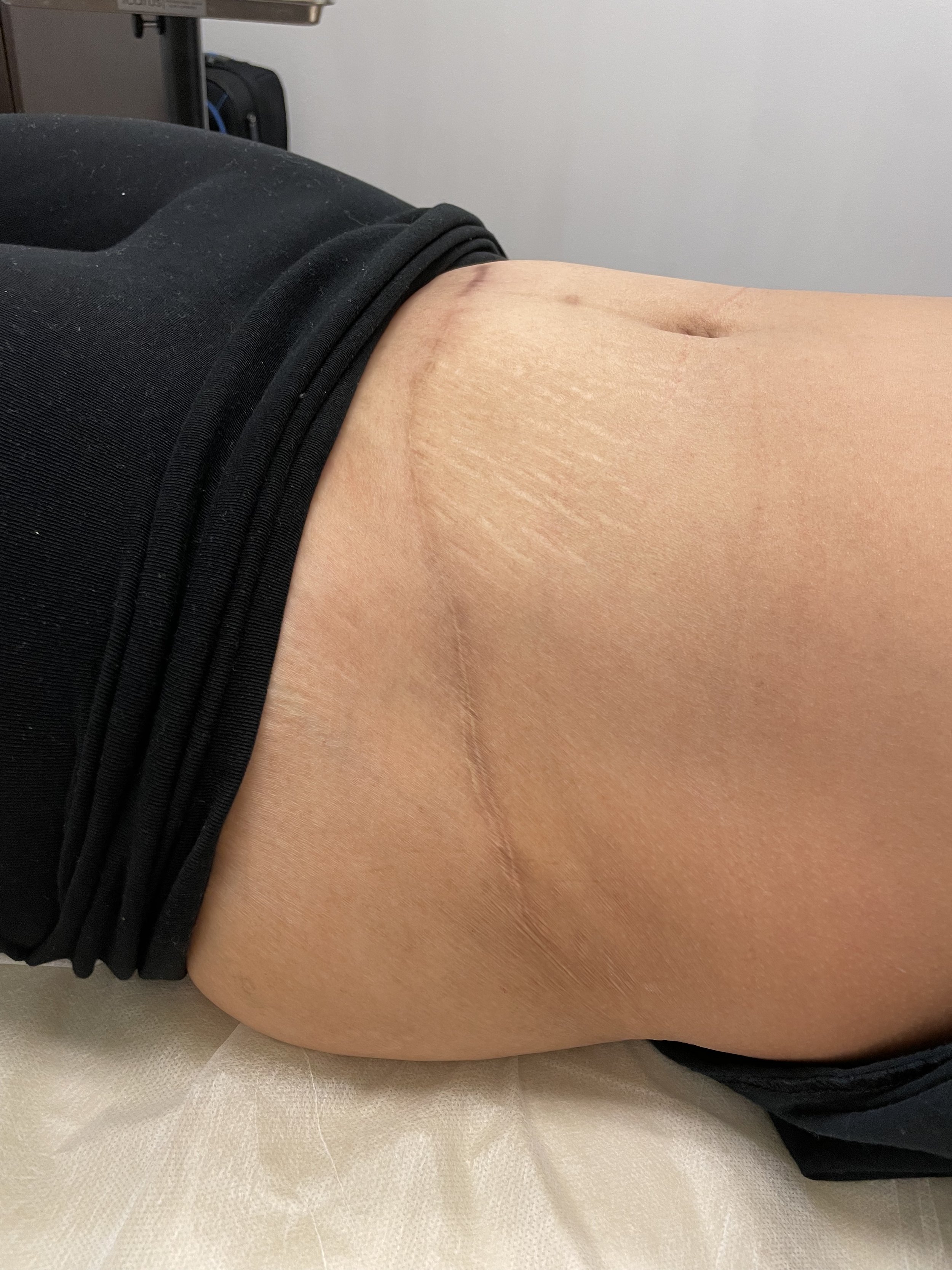 Can scars be camouflaged with skin tone tattoo ink Ink Illusions #2 Can scars be camouflaged with skin tone tattoo ink Ink Illusions